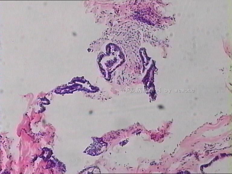 右上肢赘生物，请老师给予指点。谢谢。皮肤圆柱瘤？？？？图7