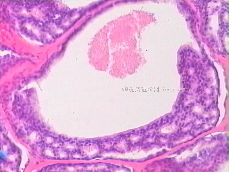 右上肢赘生物，请老师给予指点。谢谢。皮肤圆柱瘤？？？？图13