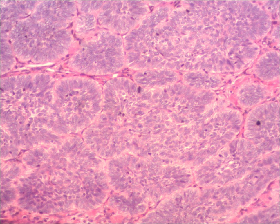 头皮基底细胞癌色素型图1