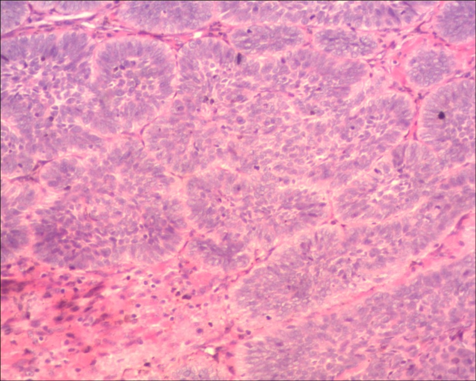 头皮基底细胞癌色素型图2