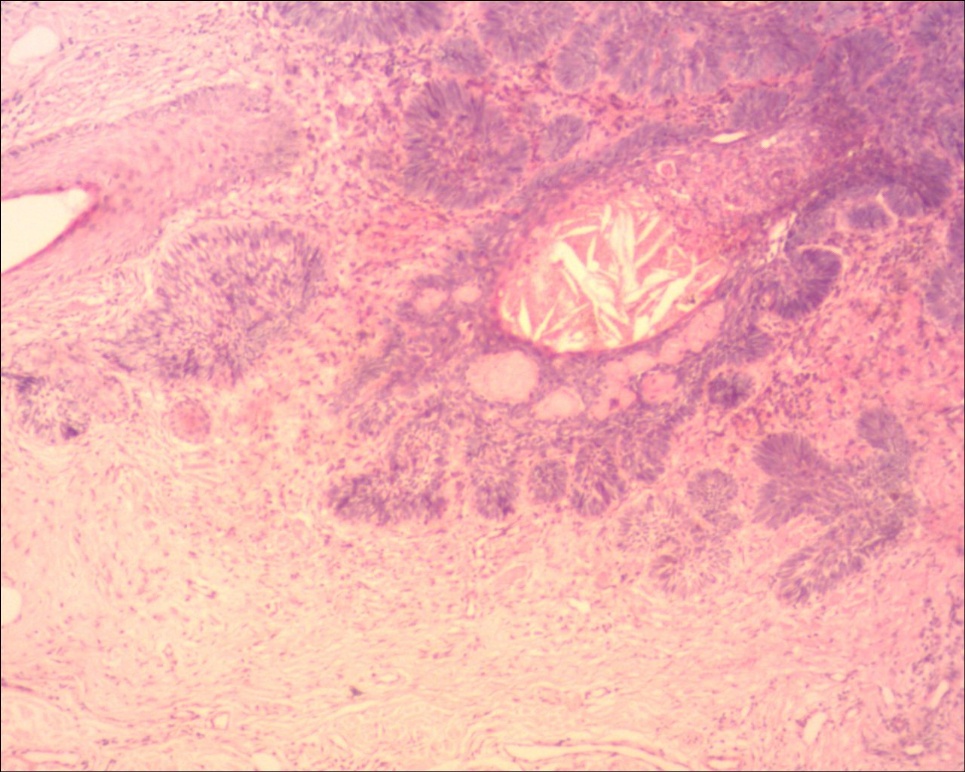 头皮基底细胞癌色素型图3