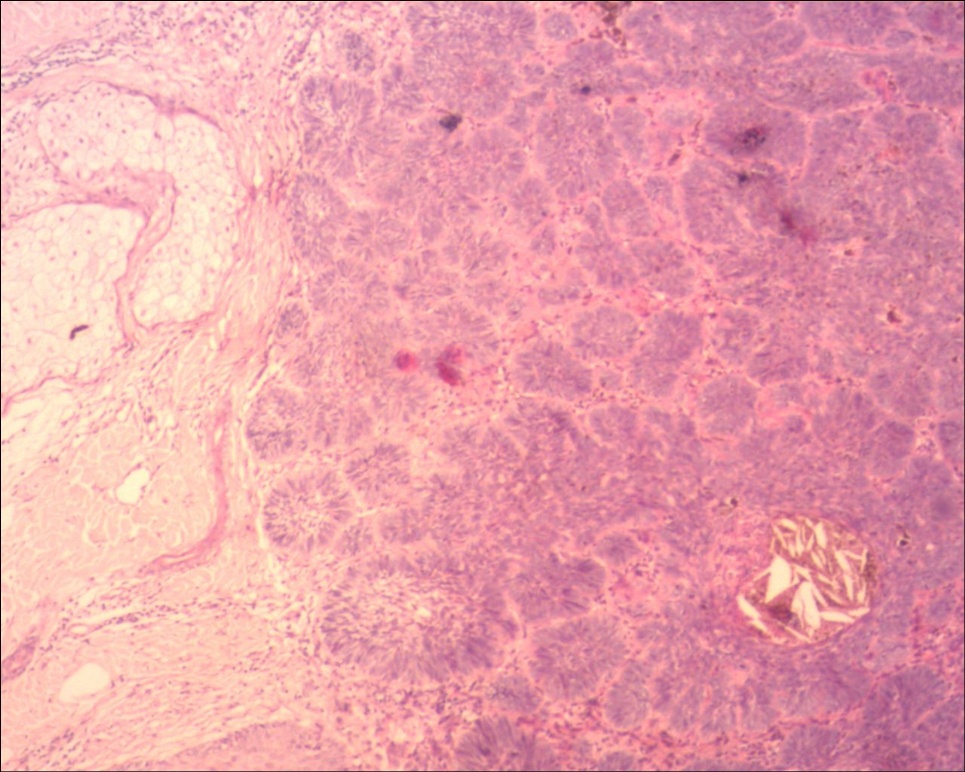 头皮基底细胞癌色素型图4