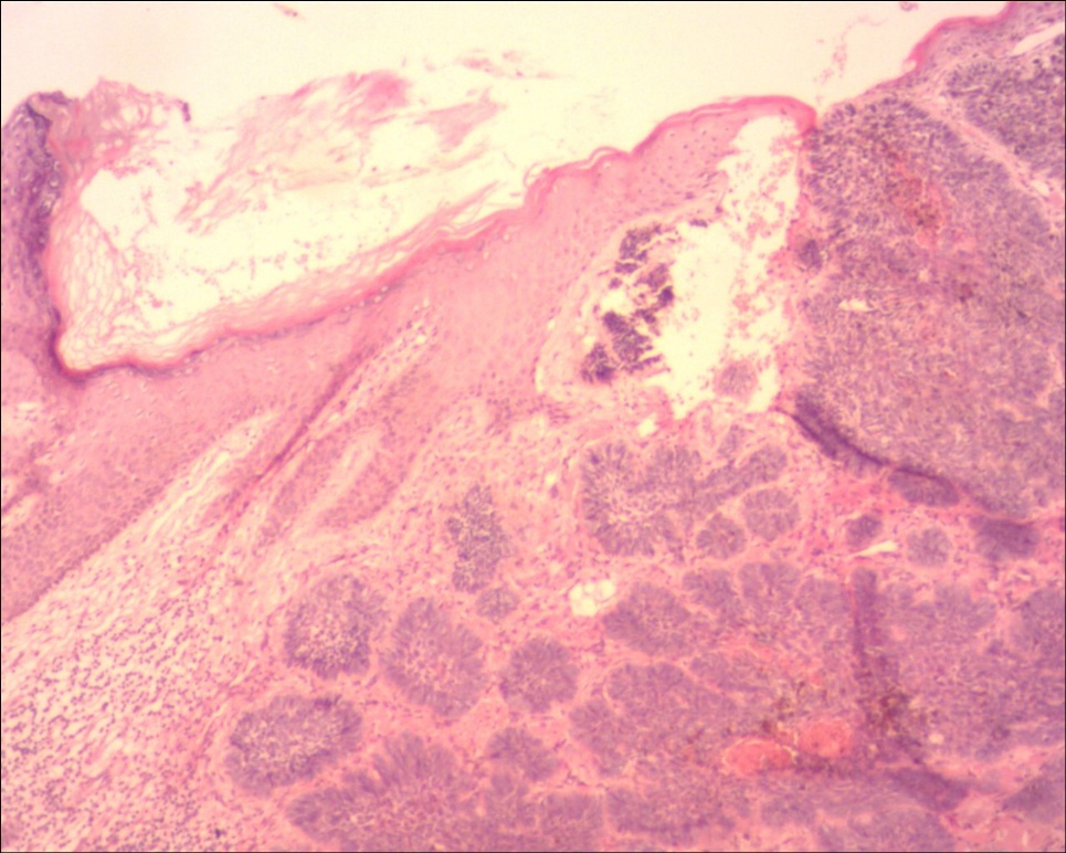 头皮基底细胞癌色素型图5