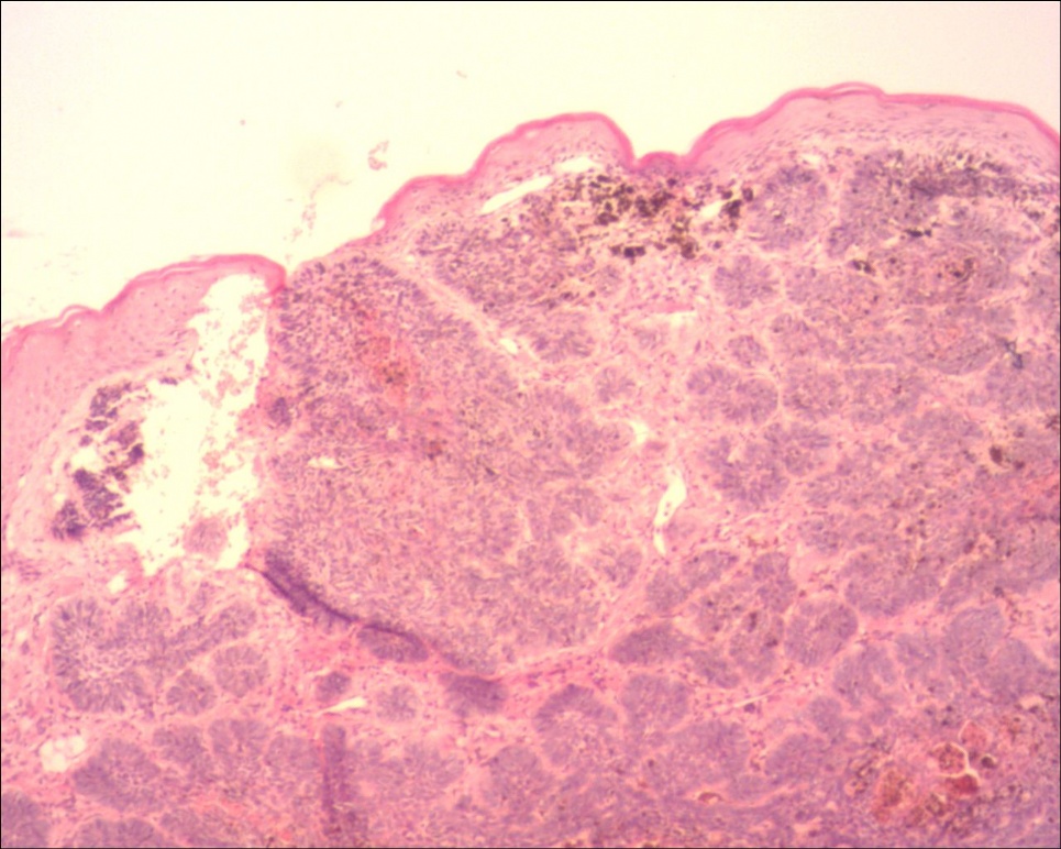 头皮基底细胞癌色素型图6
