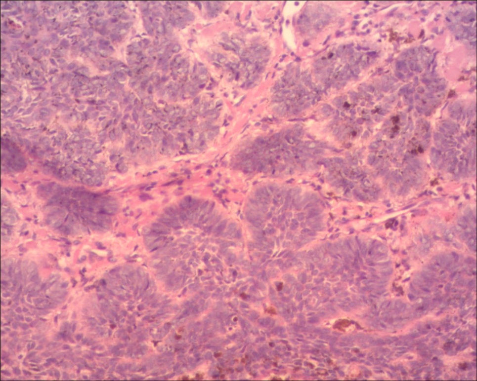 头皮基底细胞癌色素型图8