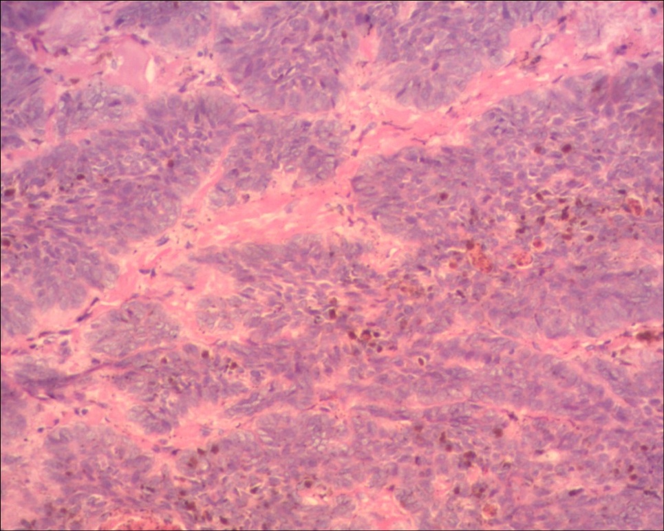头皮基底细胞癌色素型图9