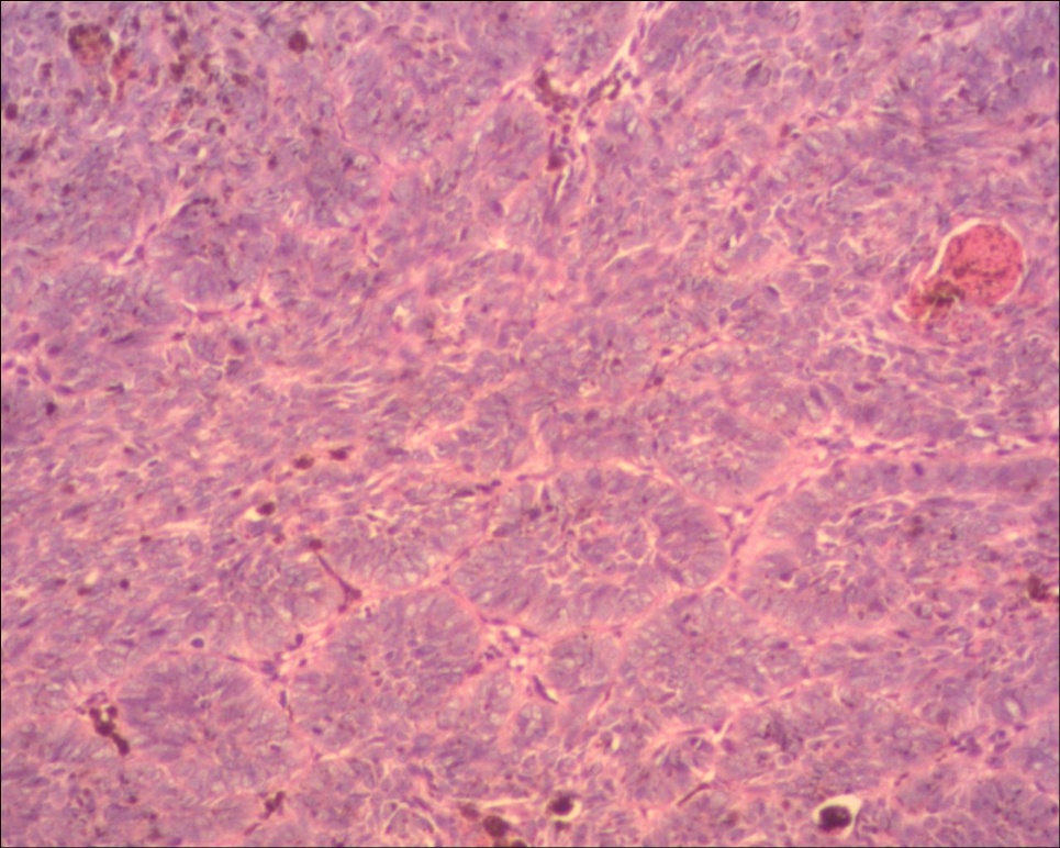 头皮基底细胞癌色素型图10