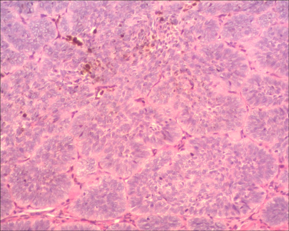头皮基底细胞癌色素型图11