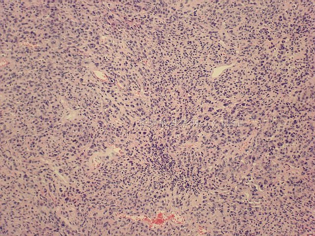 右顶部脑膜瘤（P103140）图3