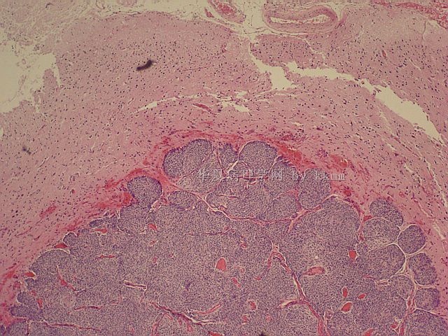 右顶部脑膜瘤（P103140）图6