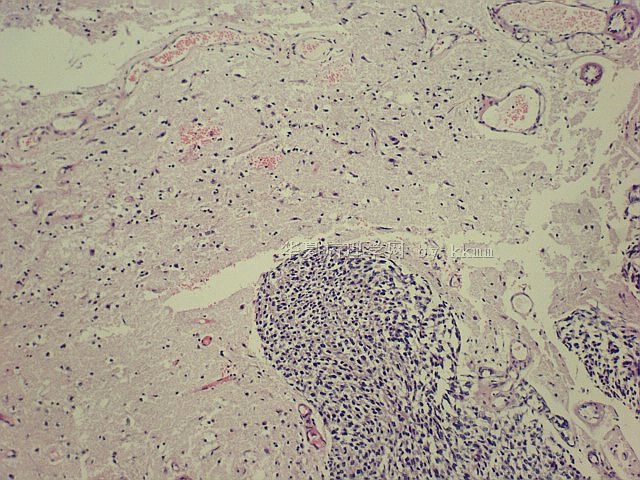 右顶部脑膜瘤（P103140）图8