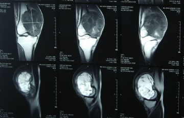 右股骨远端骨肿瘤图1