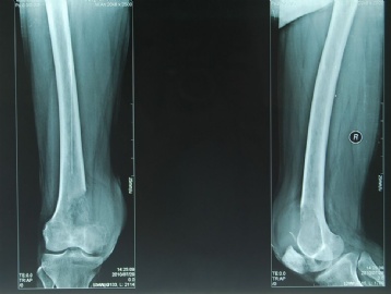 右股骨远端骨肿瘤图2
