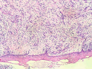 间质瘤？炎性肌纤维母细胞瘤？图1