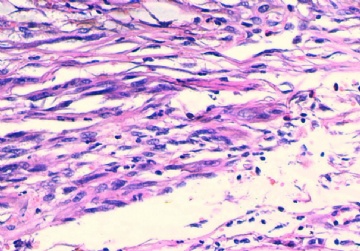 间质瘤？炎性肌纤维母细胞瘤？图10