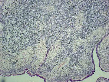 卵巢肿瘤（P103302）图3