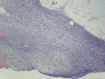 卵巢肿瘤（P103302）图6