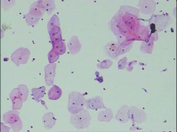 患者，26岁，宫颈液基HE染色图1