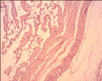 血管内乳头状内皮细胞增生（Masson血管瘤）？图1
