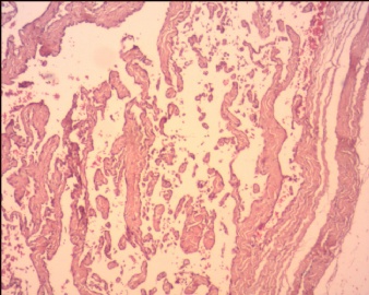 血管内乳头状内皮细胞增生（Masson血管瘤）？图2