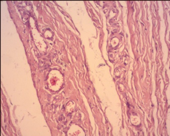 血管内乳头状内皮细胞增生（Masson血管瘤）？图11