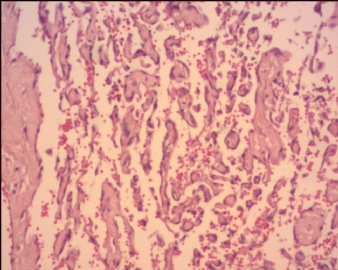 血管内乳头状内皮细胞增生（Masson血管瘤）？图12