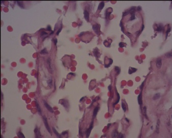 血管内乳头状内皮细胞增生（Masson血管瘤）？图15