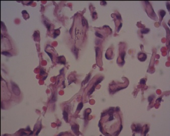 血管内乳头状内皮细胞增生（Masson血管瘤）？图16