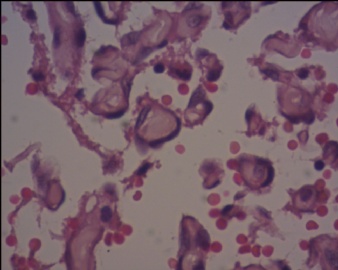 血管内乳头状内皮细胞增生（Masson血管瘤）？图18