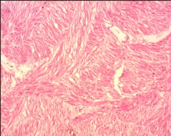 胎盘滋养细胞肿瘤（pstt)图4