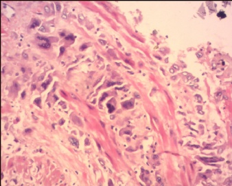 胎盘滋养细胞肿瘤（pstt)图6