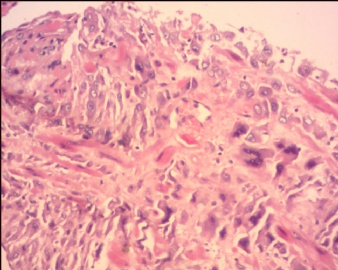 胎盘滋养细胞肿瘤（pstt)图7