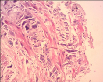 胎盘滋养细胞肿瘤（pstt)图8