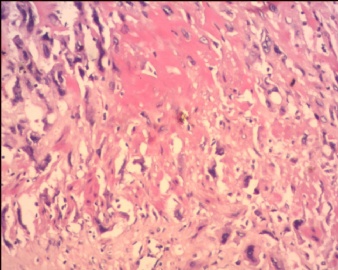 胎盘滋养细胞肿瘤（pstt)图9