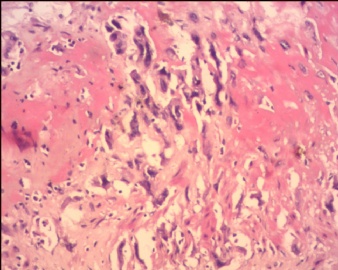 胎盘滋养细胞肿瘤（pstt)图10