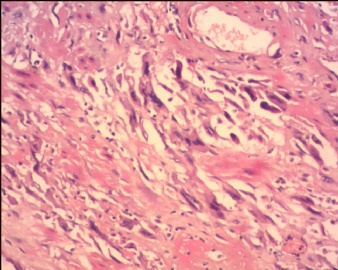 胎盘滋养细胞肿瘤（pstt)图12