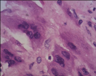 胎盘滋养细胞肿瘤（pstt)图14