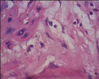 胎盘滋养细胞肿瘤（pstt)图15