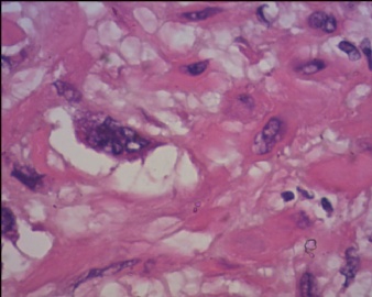胎盘滋养细胞肿瘤（pstt)图16