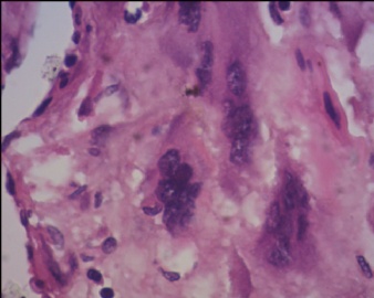 胎盘滋养细胞肿瘤（pstt)图17