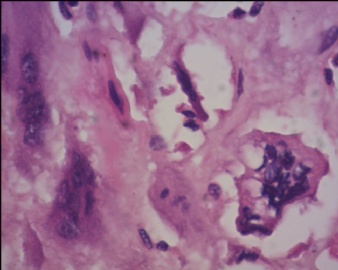 胎盘滋养细胞肿瘤（pstt)图18