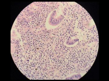 经典病例学习-慢性子宫内膜炎（新加图片）图9