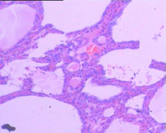 甲状腺肿瘤图12