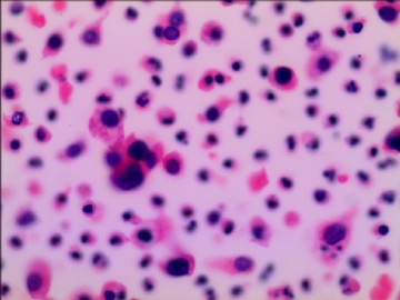 尿液液基细胞学---HE染色图3