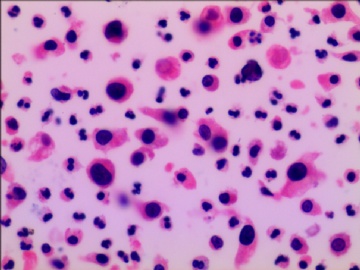 尿液液基细胞学---HE染色图4
