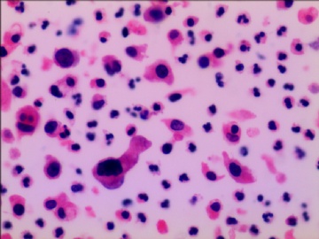 尿液液基细胞学---HE染色图5