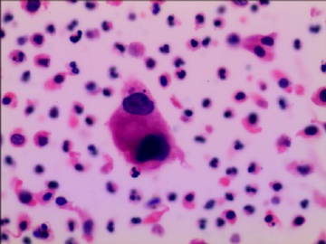 尿液液基细胞学---HE染色图6