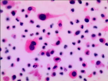 尿液液基细胞学---HE染色图7