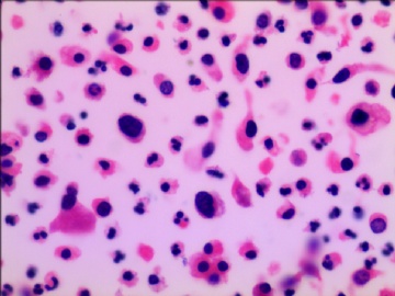 尿液液基细胞学---HE染色图8