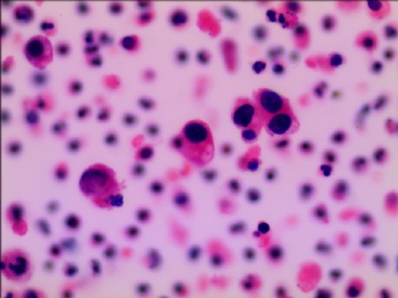 尿液液基细胞学---HE染色图9